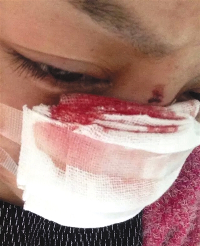 　李云鼻子被割后仍在治療。網(wǎng)絡(luò)截圖